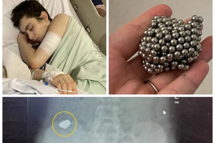 Boy Almost Died After He Swallowed 54 Magnets To See If Metal Would Stick To His Stomach